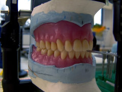 Totale Prothese, Zähne in Wachs aufgestellt für Einprobe